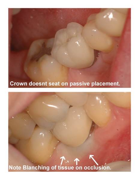 Implant seating pg 2 edited_resize final.jpg
